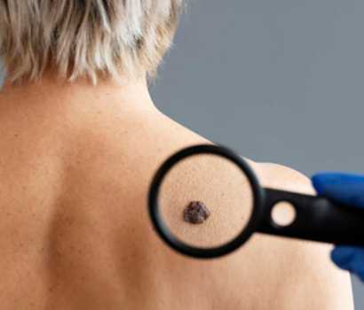Mole Removal